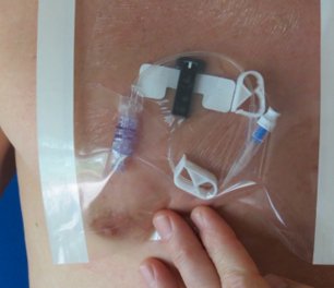 HydroSeal IV Site Barrier Protector, 9 x 9 Inch HS9X9