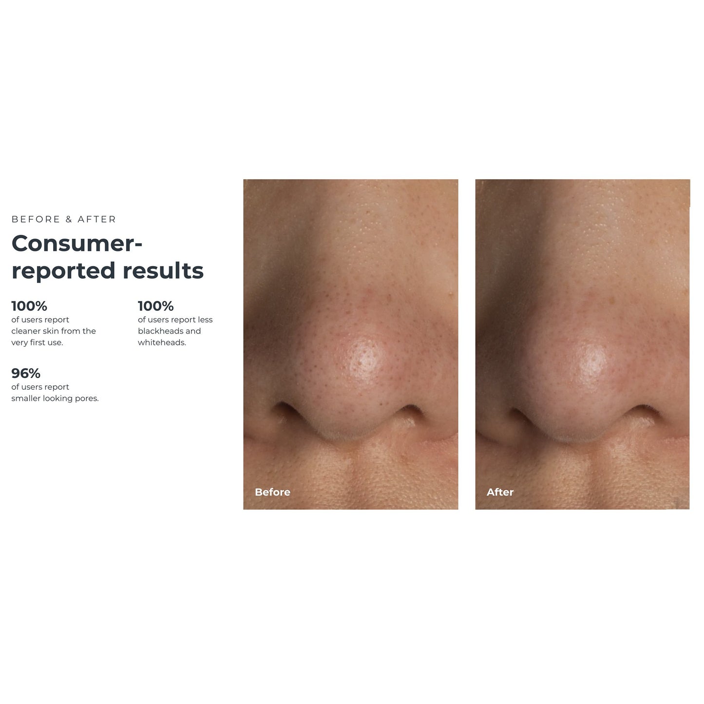 KIWI™ Blackhead Remover Pore Vaccum F1948