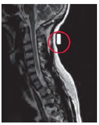 Radiology Skin Marker MRI Spee-D-Mark™ Oblong General Use SDM-MR3