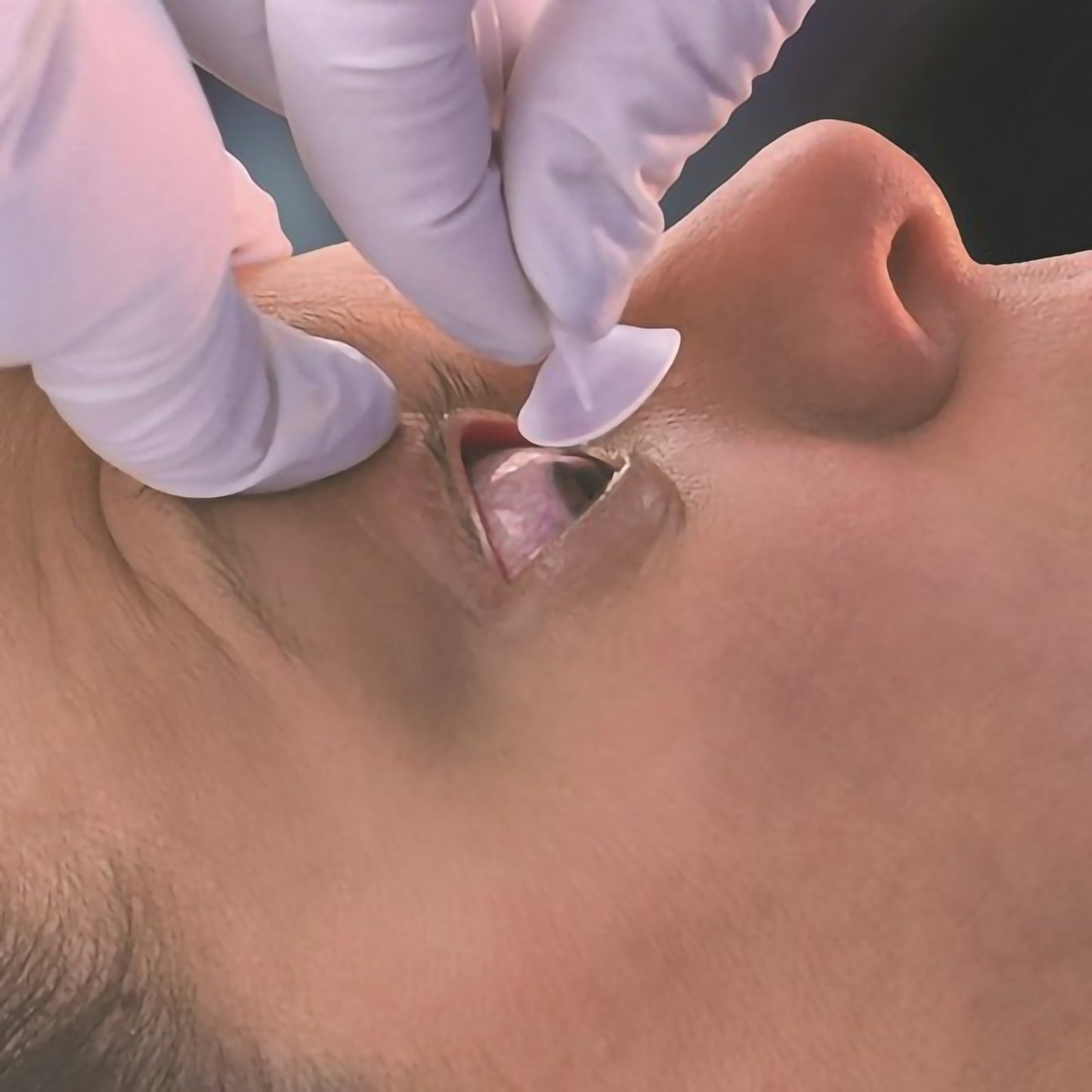 Morgan® Lens Eye Irrigation System MT2000