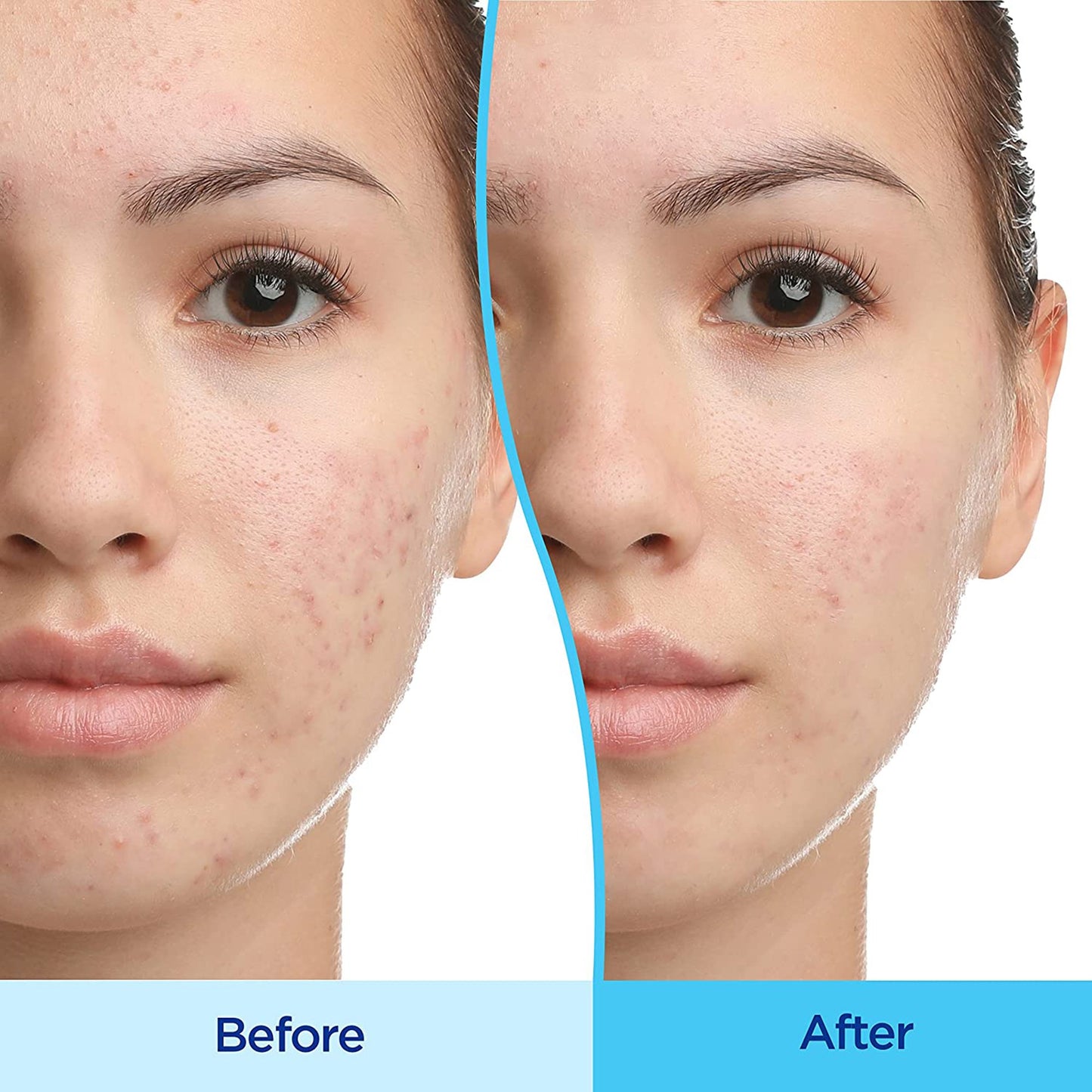 Differin Gel Acne Treatment 00299492030