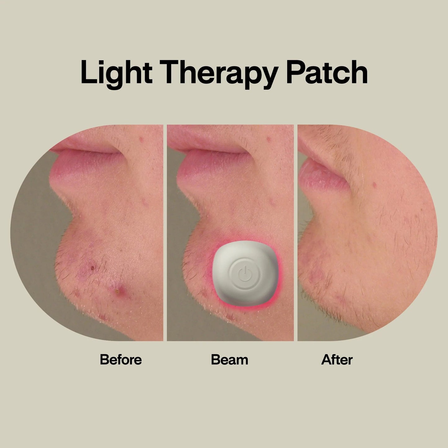 Acne Light Therapy Patch Kit ACDUO