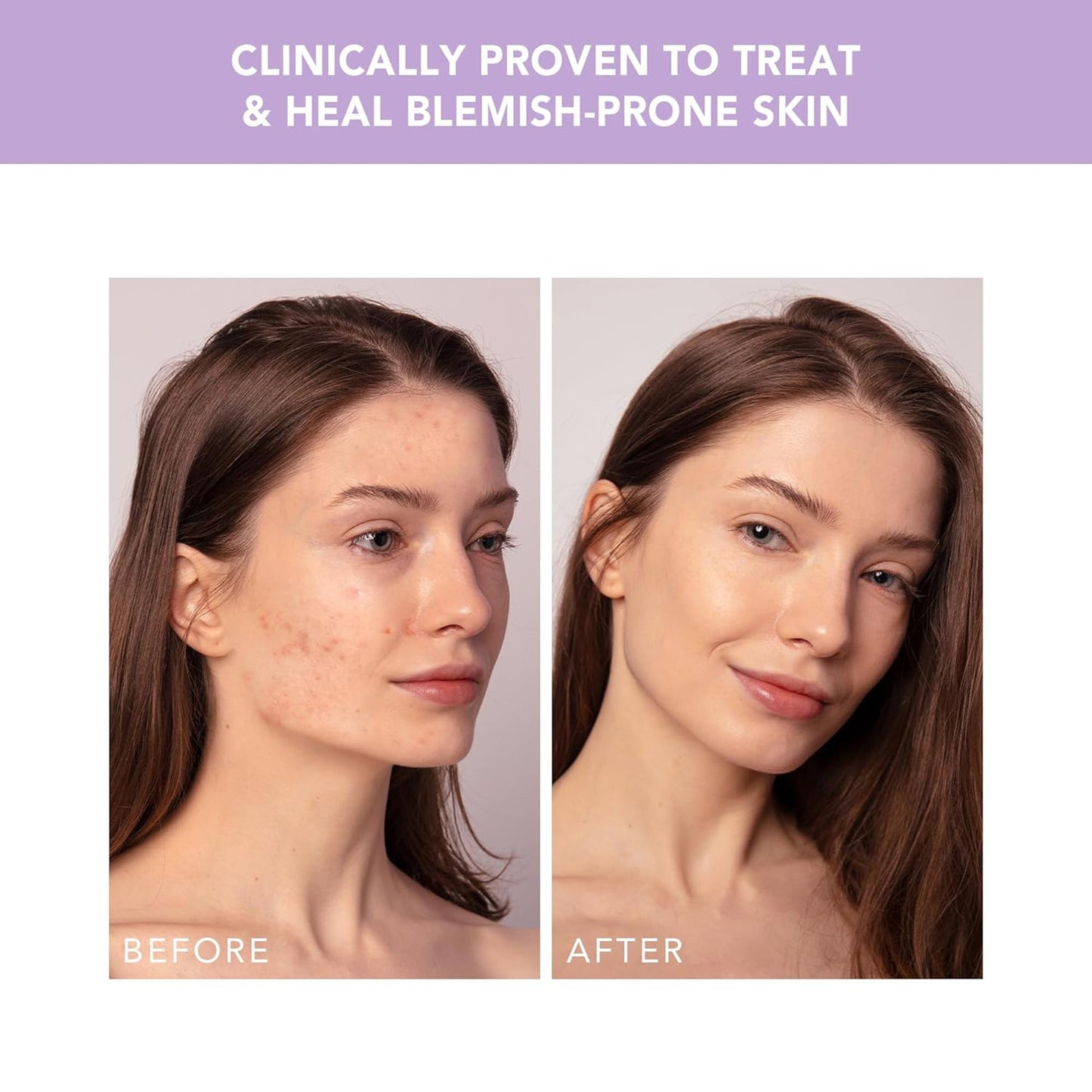 ESPADA™ 2 Plus Acne Therapy Device, Lavender F1757