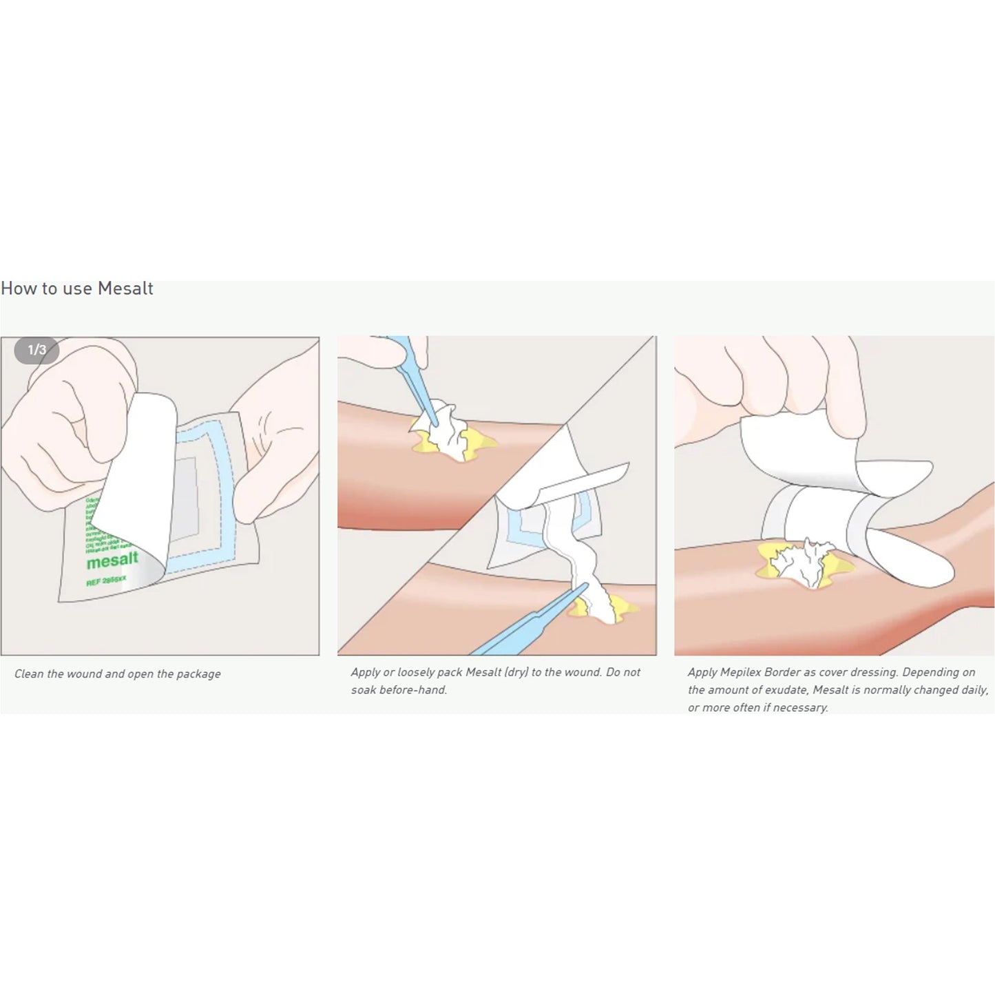 Mesalt® Sodium Chloride Impregnated Dressing, 6 x 6 inch 285780