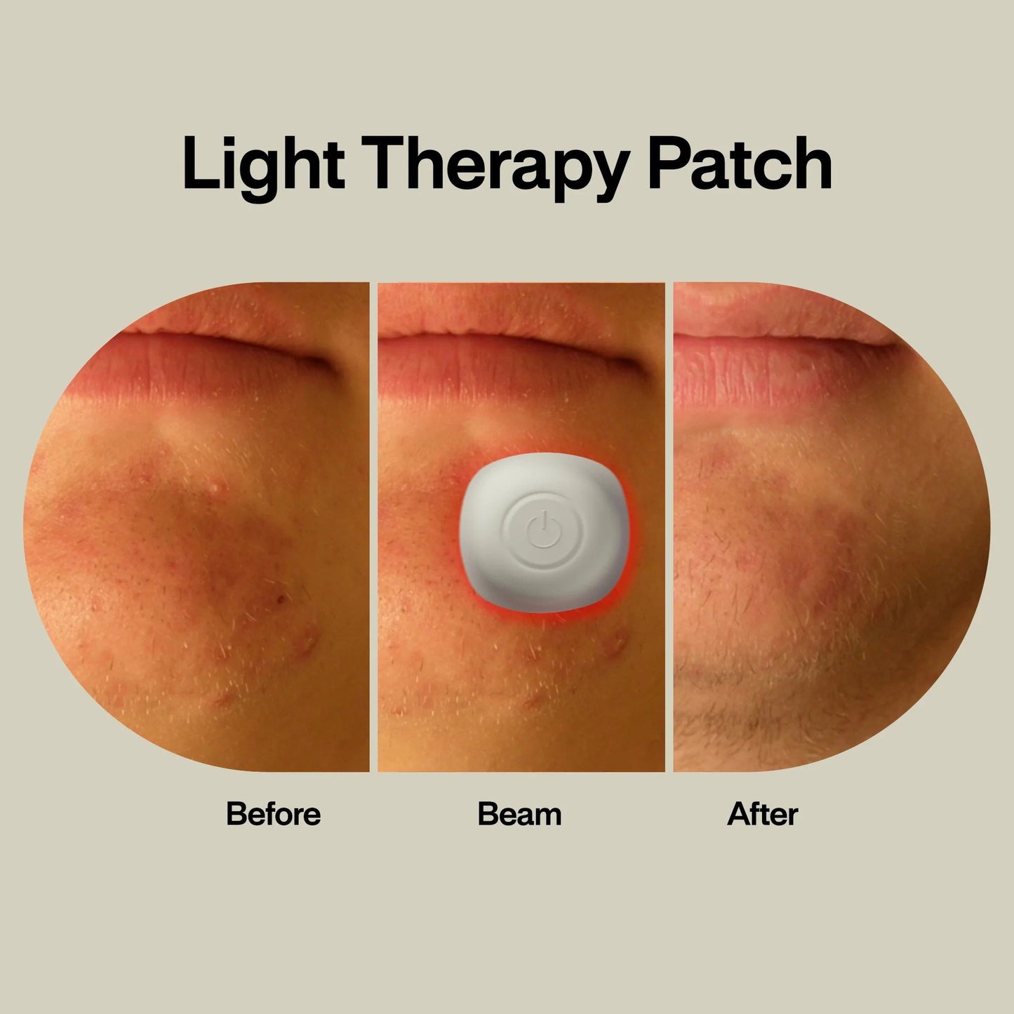 Acne Light Therapy Patch Kit lab ACPOD