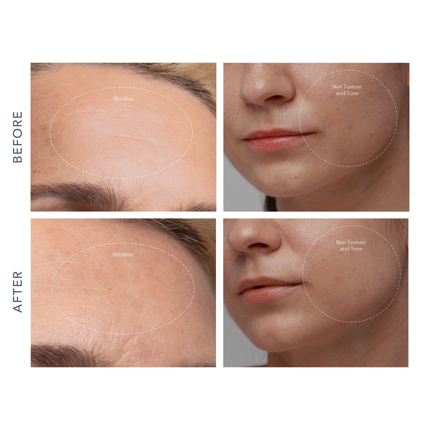 KIWI™ derma Microdermabrasion Pore Vacuum F1955