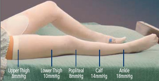 Cardinal T.E.D. Thigh High Anti-embolism Stockings, 2X-Large / Long 3185LF, PR