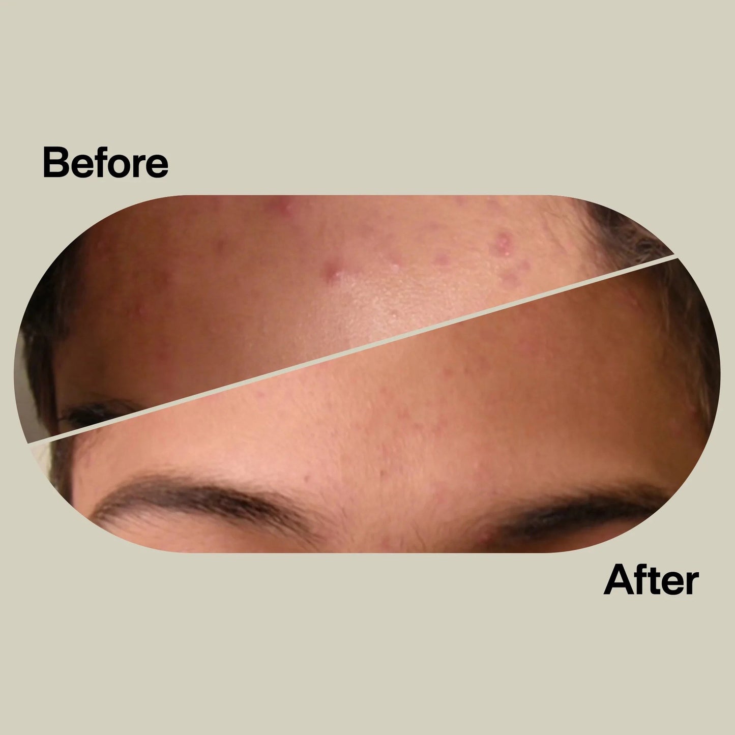 Acne Light Therapy Patch Kit ACDUO