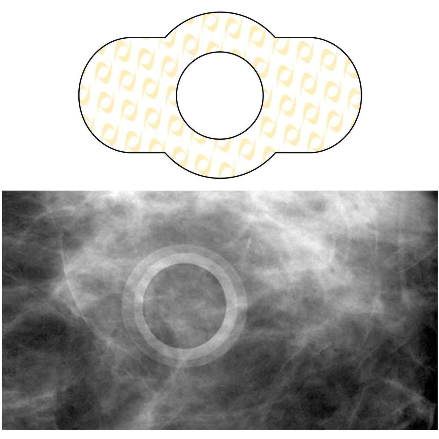 Radiology Skin Marker Spee-D-Ring™ - SDG-M612